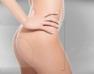 cuánto duran los implantes de glúteos