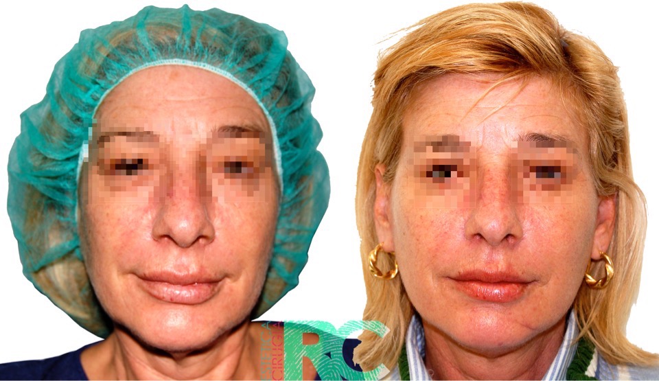 LIFTING FACIAL MADRID