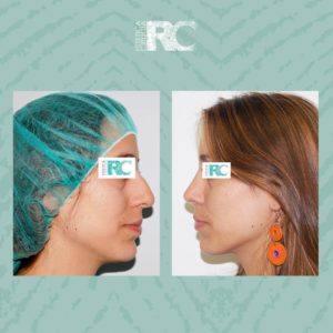 candidato rinoplastia