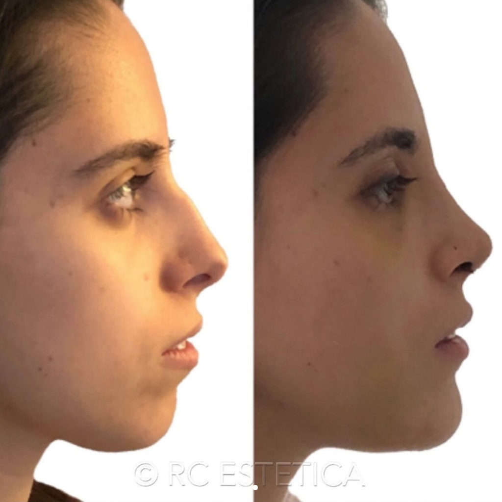 perfiloplastia madrid