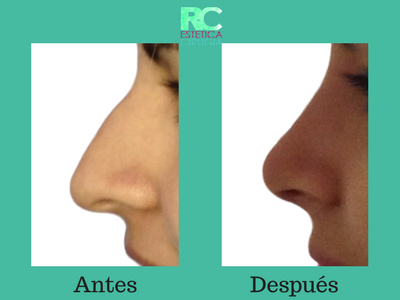 que es la rinoplastia