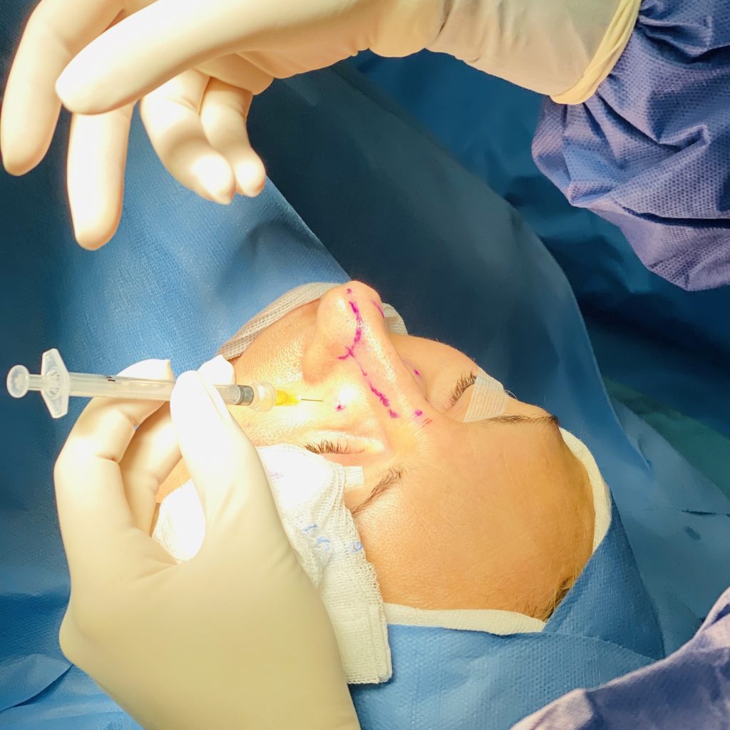 rinoplastia madrid1
