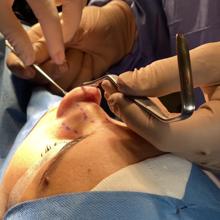 rinoplastia madrid