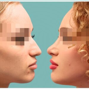 rinoplastia-ultrasonica-estructural
